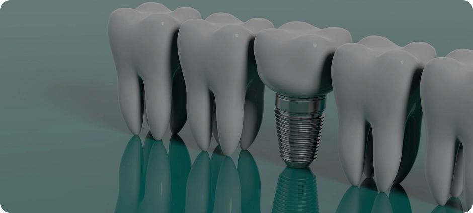 Импланты на всю жизнь